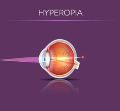 Illustration of hyperopia