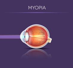 Illustration of myopia